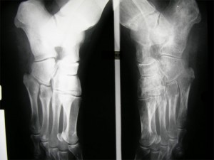 Algodystrophie du pied gauche (radiographies des pieds) 