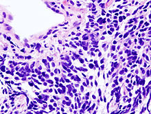 Cancer bronchique à petites cellules