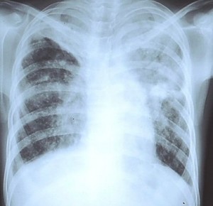 Miliaire tuberculeuse