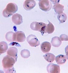 Blood smear showing plasmodium falciparum within red blood cells