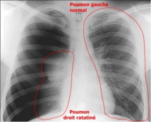 Radiographie Pneumothorax 