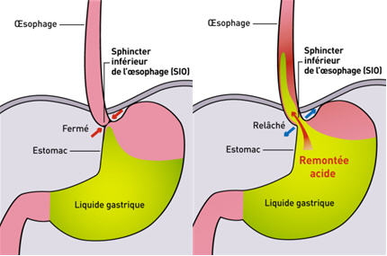 Reflux gastro-œsophagien