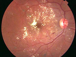 Diabetic retinopathy preproliferative