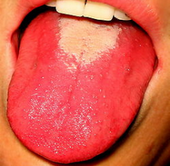 Aspect de langue dépapillée au cours de la scarlatine