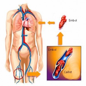 Mécanisme de l'embolie pulmonaire