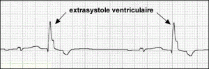 Extrasystole ventriculaire
