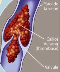 Thrombose veineuse profonde