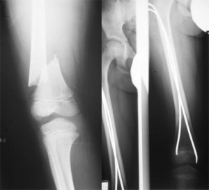 Diaphyseal fractures of the lower limb