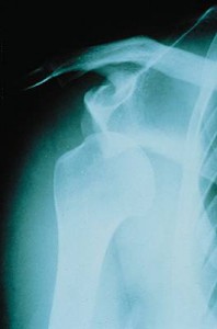 Luxation de l'épaule radiologie