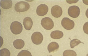 Schistocytes, indicating hemolytic anemia mechanically.