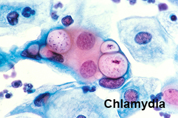 Chlamydia trachomatis de la lymphogranulomatose vénérienne (ou maladie de Nicolas Favre)