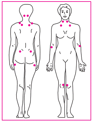 Figure 1. Les points douloureux de la fi bromyalgie.