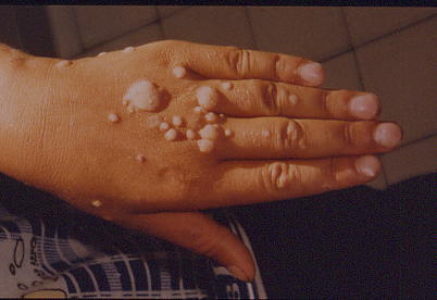 papillomavirus sur peau)