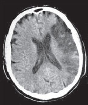 Figure 1. Aspect scanner d’un infarctus sylvien gauche étendu, révélé par une aphasie globale et une hémiplégie gauche d’apparition soudaine