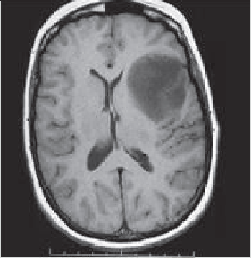 Figure 2. Aspect IRM d’une tumeur astrocytaire gauche révélée par une aphasie progressive « atypique »