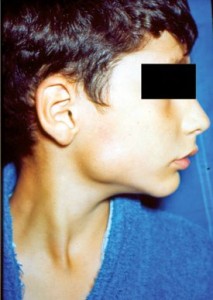 Parotidomegaly (mumps)