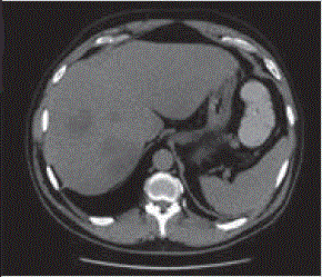 Figure 4. Hepatic abscess is diverticulitis (CT, cross-sectional).