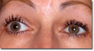 Anomalies pupillaires
