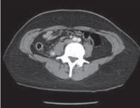Figure 2. Diagnostic de l’appendicite par TDM abdominale (coupe transversale).