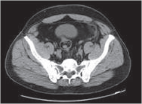 Figure 3. Diagnostic de l’appendicite par TDM abdominale (coupe transversale).
