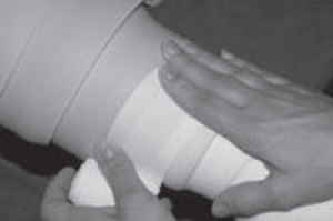 Figure 1. Bandage avec des bandes peu élastique Somos® sur un capitonnage de mousse NN® pour un lymphoedème secondaire du membre supérieur.