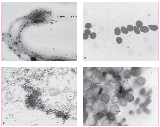 Figure 1. Cytoponctions de thyroïde. Examen après étalement et coloration de May-Grundwald-Giemsa grossi 100 fois (a et c) et 1 000 fois (b et d). De la colloïde et des groupes de cellules vésiculaires équidistantes (a) avec des noyaux réguliers de petite taille (b) sur cette cytoponction de lésion bénigne. Des groupes tridimensionnels (c) de cellules aux noyaux volumineux, incisurés avec pseudo-inclusion nucléaire (d) permettent d’évoquer le diagnostic de carcinome papillaire de la thyroïde. (Remerciements au Dr Marianne Ziol, hôpital J. Verdier, pour ces images.)