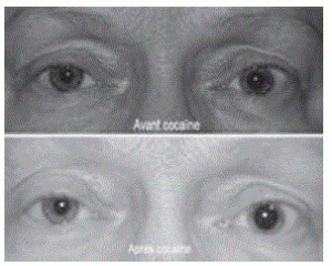 Figure 2. Dissection de la carotide droite. La cocaïne dilate la pupille saine mais n’a pas d’effet sur la pupille atteinte