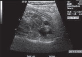 Figure 1. Ultrasound diagnosis of acute appendicitis.
