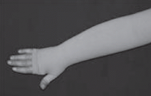 Figure 2. Manchon de compression élastique prenant la main pour lymphoedème secondaire du membre supérieur après cancer du sein.