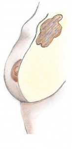 Nodule mammaire