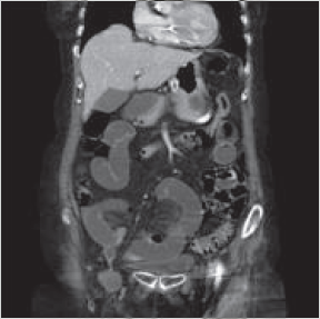 Figure 6. Occlusion sur hernie inguinale (TDM abdominale, coupe sagittale).