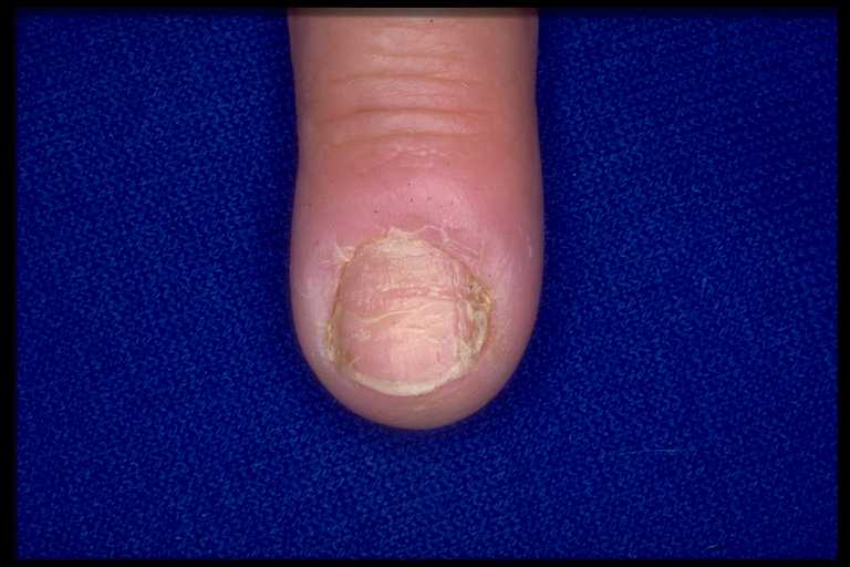 Pathologie des ongles (Périonyxis)