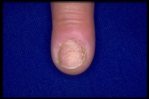 Pathology nails (Paronychia)