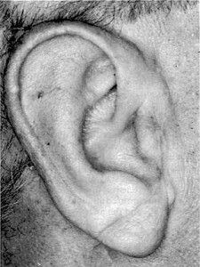 Oblique fold of the ear