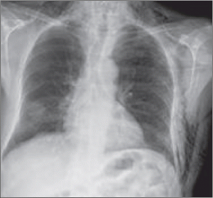 Figure 1a. Radiographie du thorax de face. Emphysème sous-cutané diffus avec visibilité des fibres musculaires du pectoral. Opacité ronde parenchymateuse de découverte fortuite.