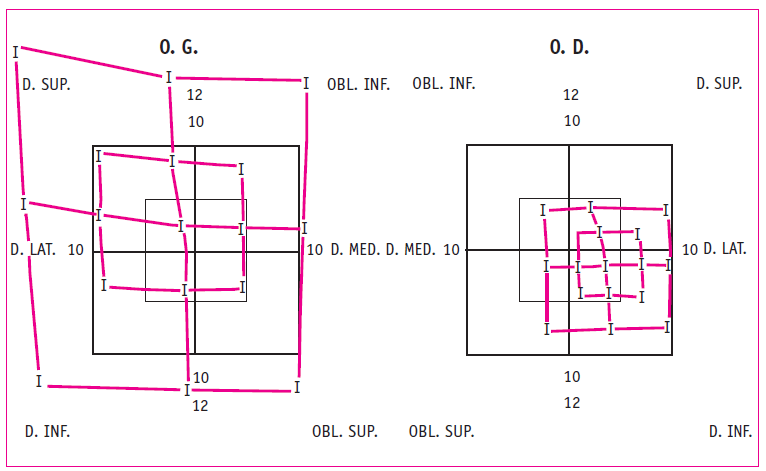Figure 2. Schéma de Lancaster. Ce schéma visualise une paralysie du III Droit. Le petit quadrilatère rouge correspond au côté de l’oeil atteint