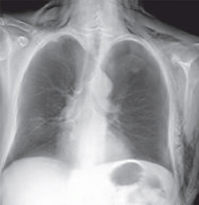 Figure 1b. Tomosynthèse pulmonaire de face. Mise en évidence d’un emphysème sous-cutané visible dans les parties molles autour du thorax associé à un pneumothorax apical gauche.