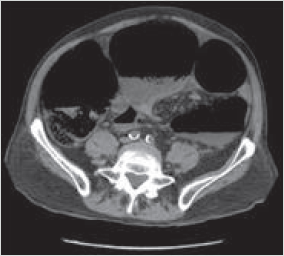Figure 5. Volvulus du sigmoïde (TDM abdominale, coupe transversale).