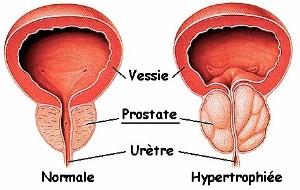 cancer de la prostate)