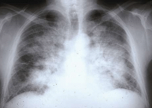 Acute Pulmonary Edema - Radiography