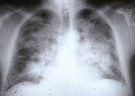 Oedème aigu du poumon