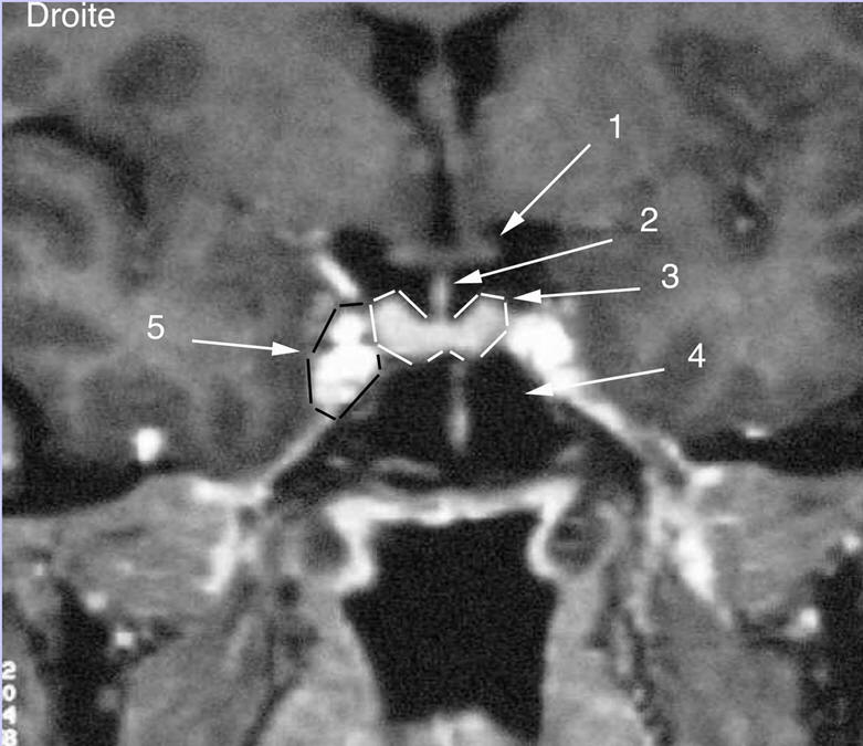 Figure 2 : IRM de la région hypothalamo-hypophysaire, coupe sagittale, séquence Ti après injection de gadolinium Image d'hypophyse normale. 1 : Chiasma optique ; 2 : Tige pituitaire ; 3 : Antéhypophyse (délimité par des tirets blancs) ; 4 : Sinus sphénoïdal ; 5 : Sinus caverneux (délimité par des tirets noirs)