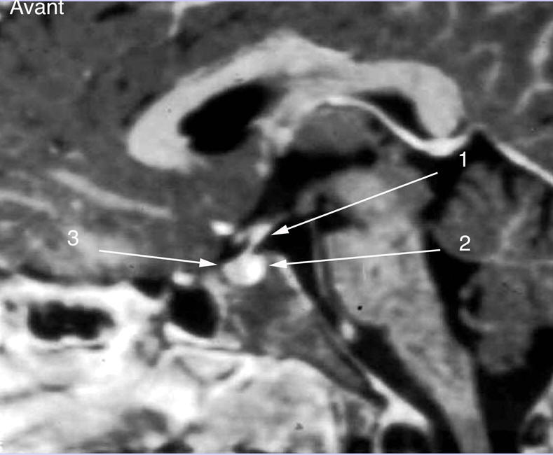Figure 3 : IRM de la région hypothalamo-hypophysaire, coupe coronale, séquence Ti après injection de gadolinium Image d'hypophyse normale.. 1: Tige pituitaire; 2 : Hypersignal de la post-hypophyse (vésicules sécrétoires riches en ADH) ; 3 : Antéhypophyse rehaussée après injection de produit de contraste.