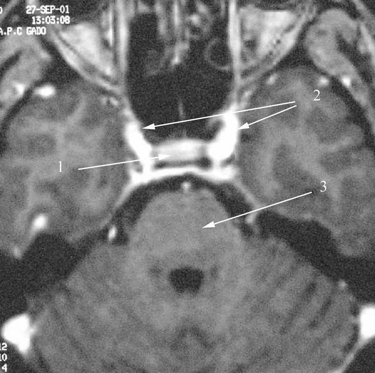 Figure 4 : IRM de la région hypothalamo-hypophysaire, séquence Ti après injection de gadolinium Hypophyse normale. La post-hypophyse, non individualisable sur cette image, est en hypersignal Ti SANS INJECTION de gadolinium. 1 : Antéhypophyse ; 2 : Carotide intra-caverneuse ; 3 : Tronc cerebral.