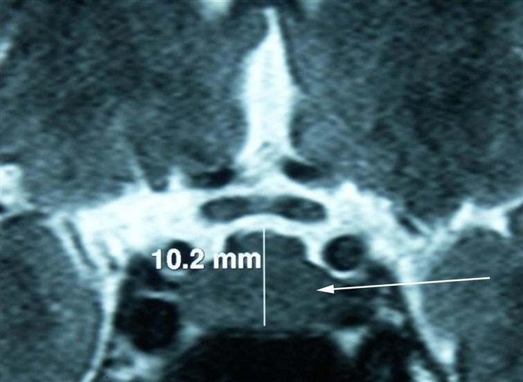 Figure 5 : IRM hypophysaire, coupe coronale, séquence T2 Hypophyse gravidique Variante anatomique : la hauteur maximale de l'hypophyse au cours de la grossesse peut atteindre jusqu'à 12 mm. Elle mesure ici 10,2 mm dans son plus grand axe (normale entre 8 et 9 mm) chez cette patiente enceinte.