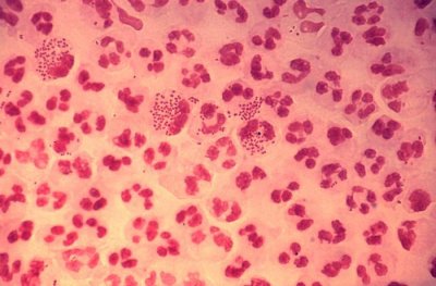 Neisseria Gonorrhoeae smear