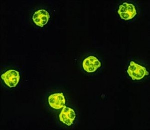 Anticorps anti-cytoplasme des polynucléaires neutrophiles (ANCA)