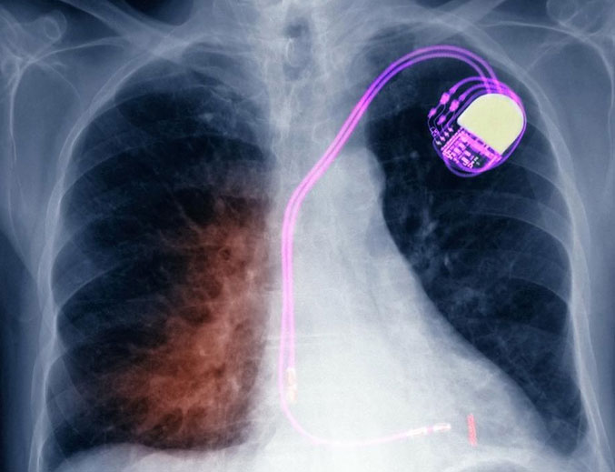 Monitoring a Patient with a Simple Pacemaker or Defibrillator