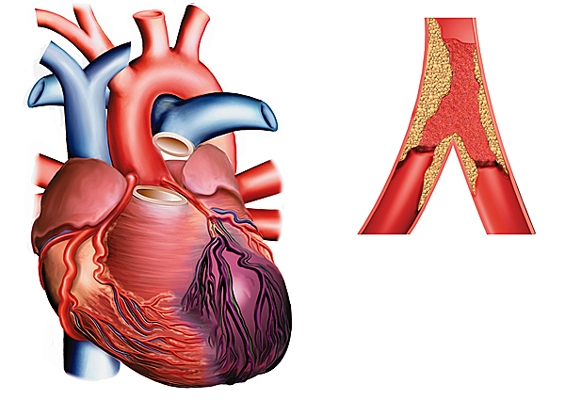 Marqueurs de l'infartus du myocarde - myoglobine, troponines et isoenzyme de la créatine-kinase