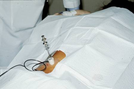 Biopsie rénale : techniques